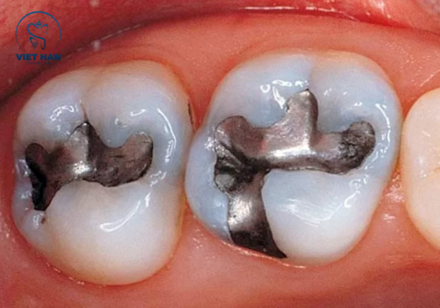 Miếng trám Amalgam là một dạng chất liệu trám răng có độ bền cao cho răng hàm chịu lực.