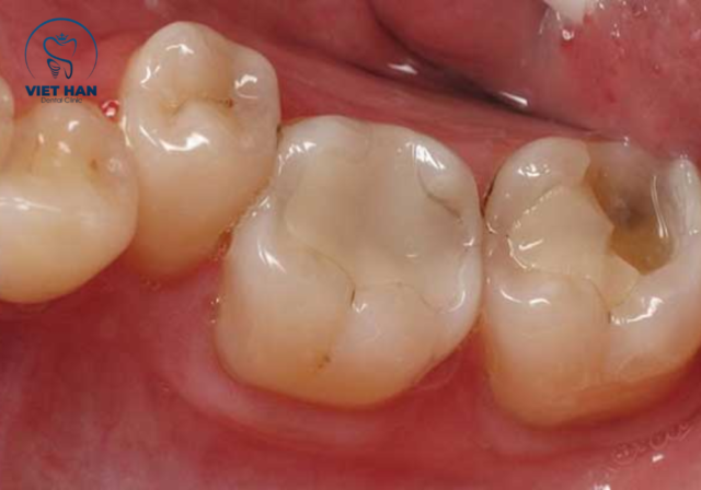 Tình trạng sâu răng nhẹ thường được xử lý nhanh chóng bằng chất liệu trám răng GIC thẩm mỹ.