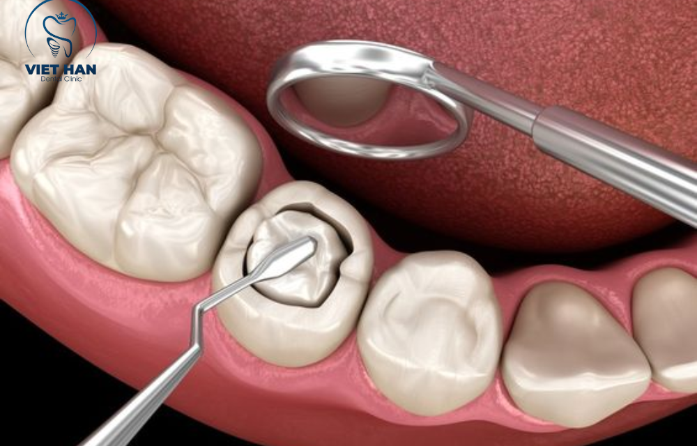 Top 5 chất liệu trám răng bền nhất hiện nay bạn nên biết