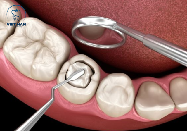 Quy trình điều trị sâu răng và phục hồi bằng chất liệu trám răng giúp bảo vệ cấu trúc răng thật.