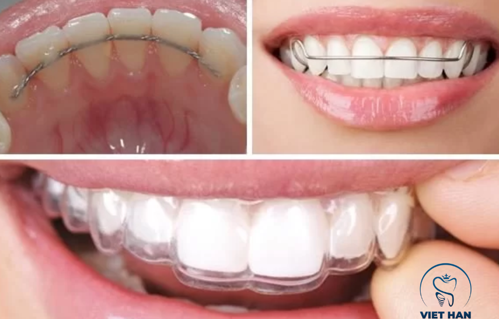 Hàm duy trì có mấy loại? Cách chọn phù hợp