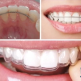 Đeo hàm duy trì giúp răng thích nghi với vị trí mới sau khi tháo niềng.