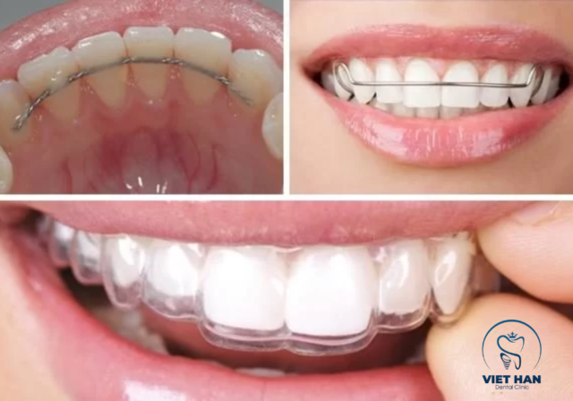 Đeo hàm duy trì giúp răng thích nghi với vị trí mới sau khi tháo niềng.