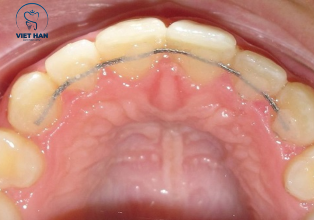 Hàm duy trì cố định gắn mặt trong răng giúp giữ răng ổn định liên tục.