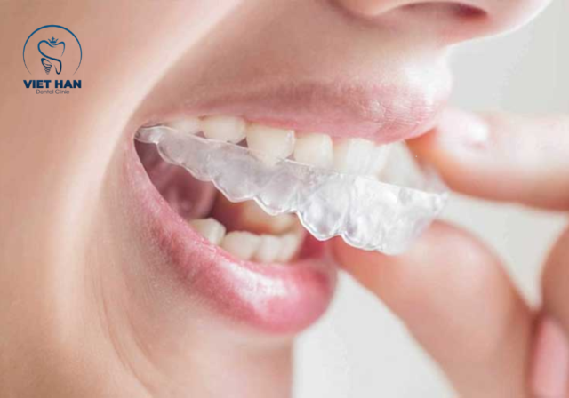 Hàm duy trì trong suốt mang lại thẩm mỹ cao và dễ tháo lắp khi ăn uống.