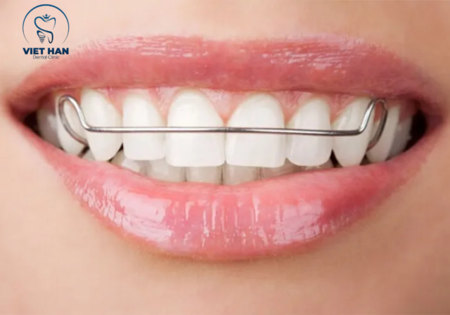 Hàm duy trì Hawley có độ bền cao và dễ điều chỉnh khi cần.