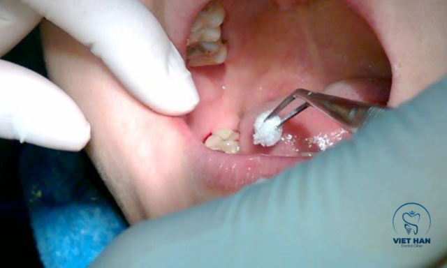 Nhổ răng khôn bằng kìm và bẩy là phương pháp truyền thống.