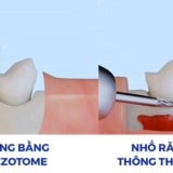 Tùy tình trạng răng và tài chính để chọn nhổ răng khôn truyền thống hoặc bằng máy Piezotome .