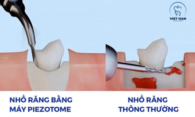 Tùy tình trạng răng và tài chính để chọn nhổ răng khôn truyền thống hoặc bằng máy Piezotome .