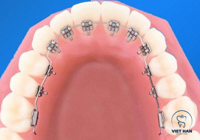 Niềng răng mặt trong hoạt động bằng lực kéo ổn định giúp răng dịch chuyển về vị trí chuẩn.