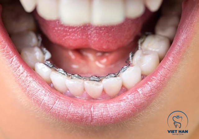 Niềng răng mặt trong đảm bảo thẩm mỹ cao nhưng cần thời gian thích nghi ban đầu.