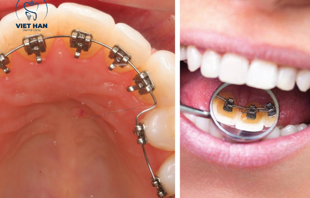 Có nên niềng răng mặt trong? Ưu nhược điểm cần biết