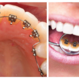 Người trưởng thành lựa chọn niềng răng mặt trong để chỉnh nha kín đáo.