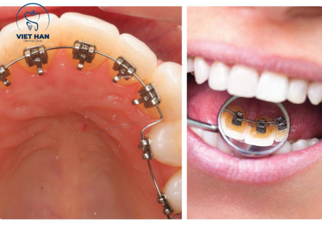 Người trưởng thành lựa chọn niềng răng mặt trong để chỉnh nha kín đáo.