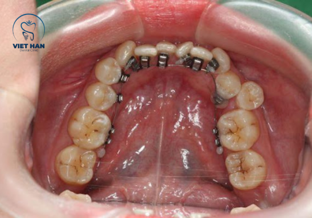 Bác sĩ gắn mắc cài niềng răng mặt trong theo kế hoạch điều trị cá nhân hóa.