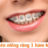 Niềng răng một hàm giúp sắp xếp răng lệch nhẹ về đúng vị trí, cải thiện thẩm mỹ nụ cười.