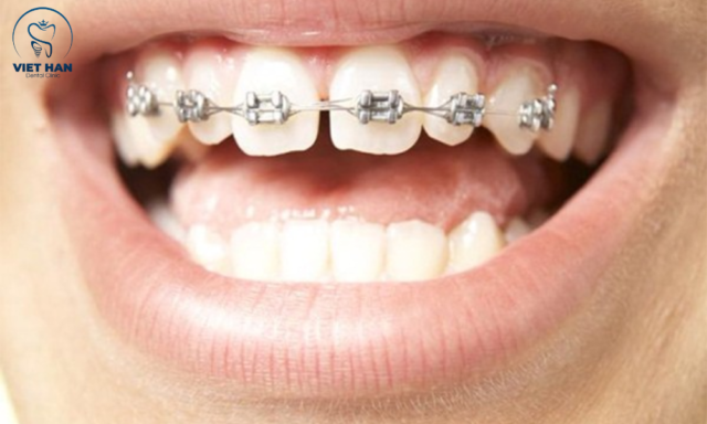 Niềng răng một hàm có thể ảnh hưởng khớp cắn nếu chỉ định không chính xác.