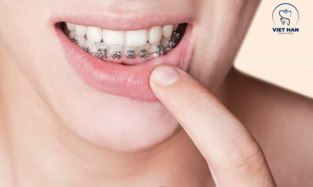 Hạn chế của niềng răng một hàm là khó đảm bảo cân đối hai hàm.