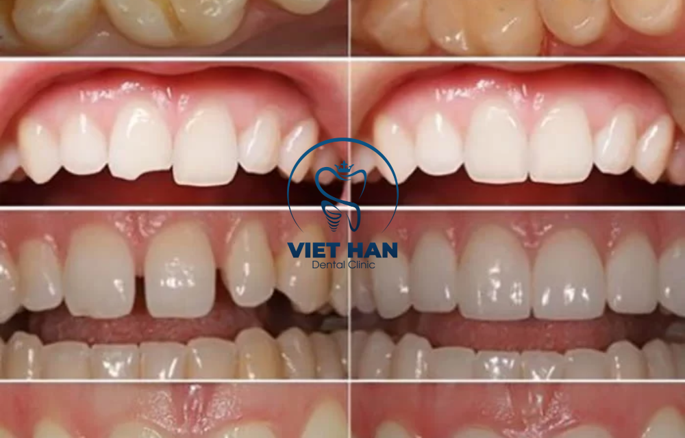 Trám răng có bền không? Bí quyết tăng tuổi thọ khi trám răng