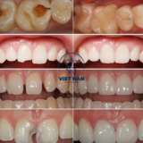 Hình ảnh trước – sau trám răng cho thấy sự cải thiện rõ rệt về thẩm mỹ và độ đều đẹp của răng.