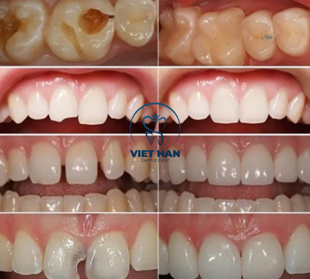 Hình ảnh trước – sau trám răng cho thấy sự cải thiện rõ rệt về thẩm mỹ và độ đều đẹp của răng.