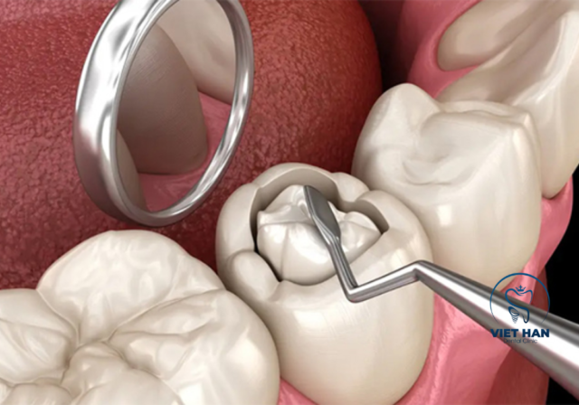 Quy trình trám răng sâu chuẩn y khoa giúp loại bỏ vi khuẩn, bảo vệ răng thật tối đa.