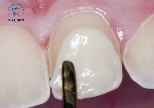 Cận cảnh trám răng: vật liệu được tạo hình tỉ mỉ, khít sát, đảm bảo thẩm mỹ và chức năng ăn nhai.