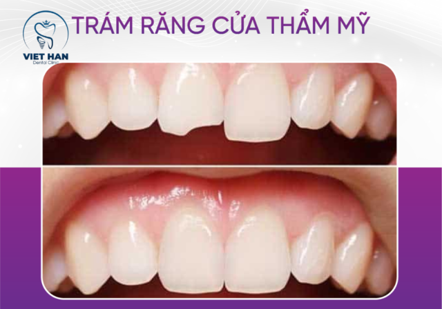 Trám răng thẩm mỹ giúp phục hồi răng mẻ, lấy lại nụ cười đều đẹp tự nhiên chỉ sau 1 lần thực hiện.