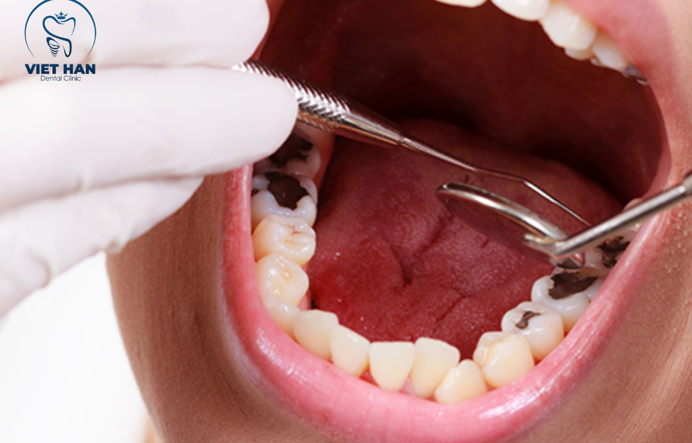 Trám răng sâu là gì? Khi nào cần trám để tránh mất răng