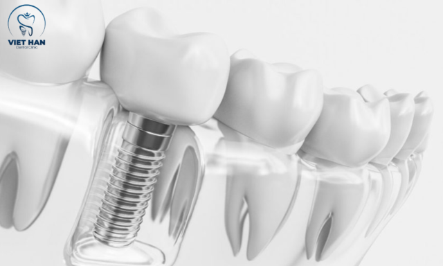 Trồng răng implant đau nhiều hay ít phụ thuộc tay nghề bác sĩ, công nghệ cấy ghép và tình trạng xương hàm từng người.