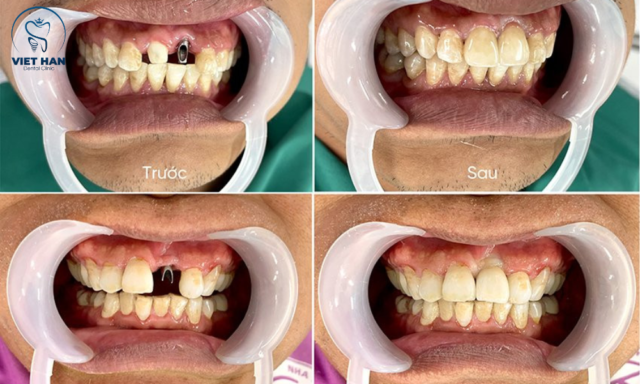 Trồng răng implant đau nhẹ 1–3 ngày đầu, sau đó giảm dần và hồi phục tốt nếu chăm sóc đúng hướng dẫn bác sĩ.