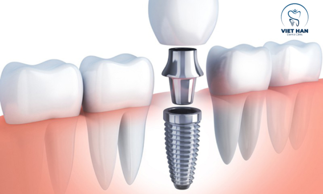 Quy trình chuẩn giúp trồng răng implant đau ít, đảm bảo đặt trụ chính xác và hỗ trợ lành thương nhanh chóng.