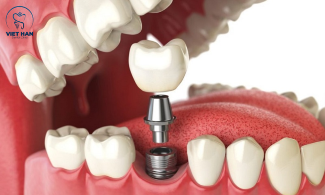 Chăm sóc đúng cách giúp trồng răng implant đau giảm nhanh, hạn chế sưng viêm và rút ngắn thời gian hồi phục.