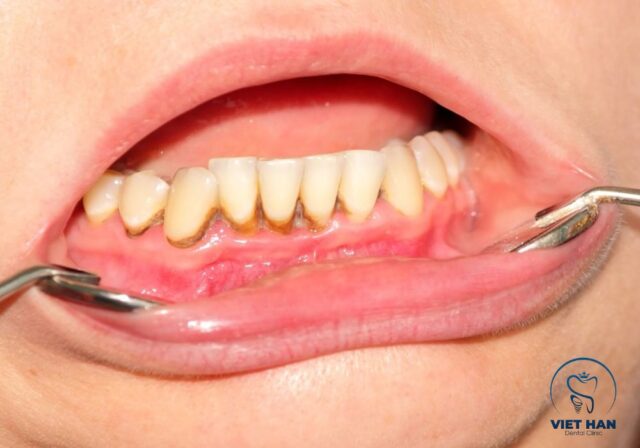 Cạo vôi răng là phương pháp loại bỏ mảng bám cứng đầu giúp răng sạch và khỏe hơn.