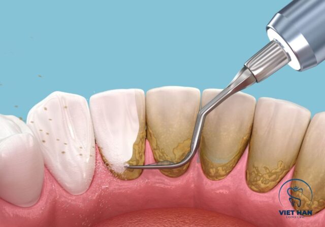 Không cạo vôi răng dễ gây viêm nướu, hôi miệng và nhiều bệnh lý răng miệng.