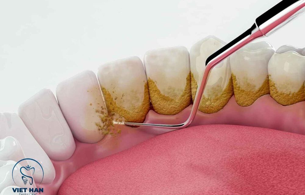 Cạo vôi răng là gì? Vì sao cần thực hiện định kỳ