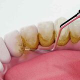 Không cạo vôi răng dễ gây viêm nướu, hôi miệng và nhiều bệnh lý răng miệng.