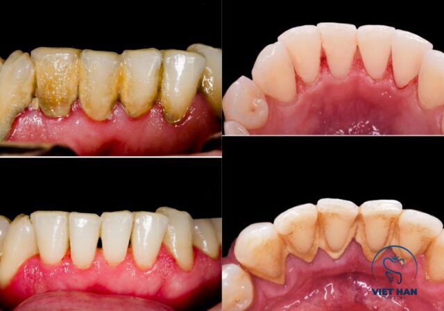 Nên cạo vôi răng 3–6 tháng/lần để duy trì sức khỏe răng miệng ổn định.