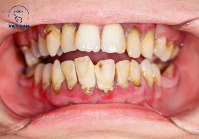 Sau khi cạo vôi răng nên tránh đồ nóng lạnh và giữ vệ sinh răng miệng đúng cách.