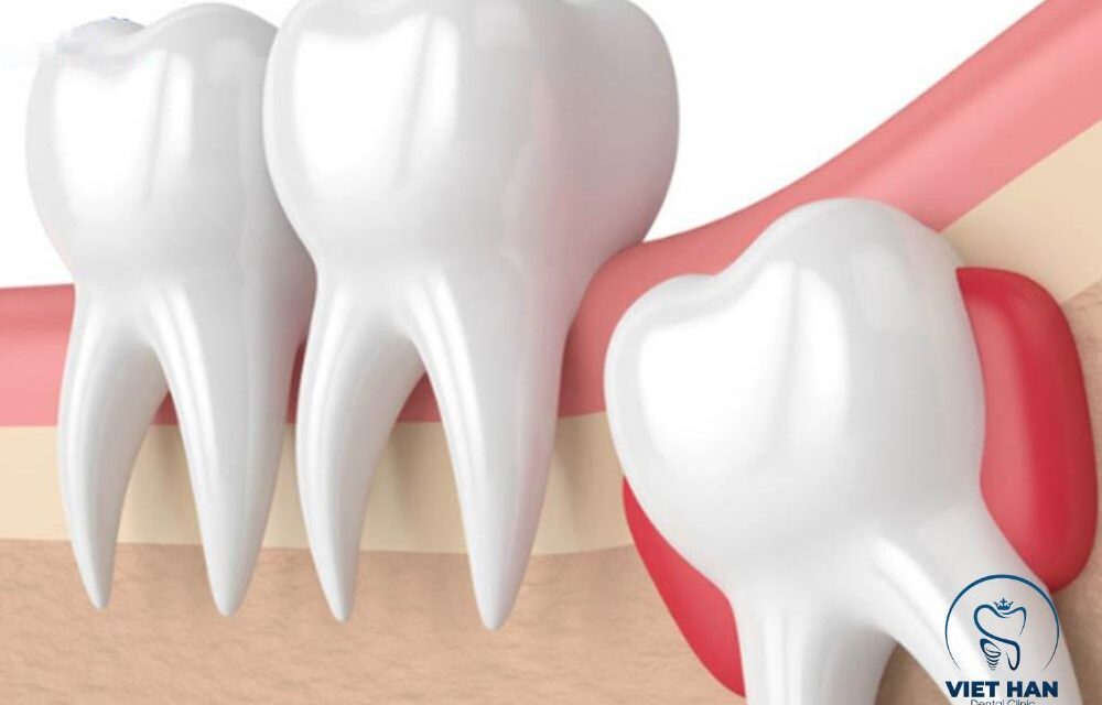 Dấu hiệu mọc răng khôn: Nhận biết để phòng ngừa biến chứng