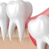 Phần lớn các dấu hiệu mọc răng khôn thường đi kèm cảm giác đau và khó chịu.