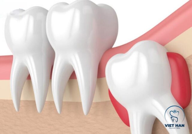Phần lớn các dấu hiệu mọc răng khôn thường đi kèm cảm giác đau và khó chịu.