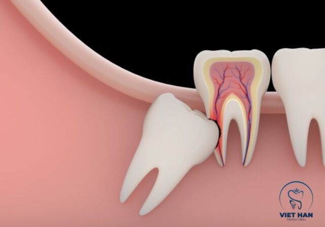 Những dấu hiệu mọc răng khôn phổ biến gồm đau nhức, sưng nướu và khó há miệng.