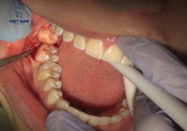 Khi dấu hiệu mọc răng khôn kéo dài, đau tăng hoặc sưng viêm, bạn nên đi khám sớm.