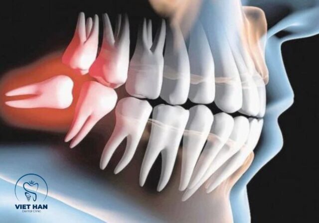 Dấu hiệu mọc răng khôn nếu bỏ qua có thể dẫn đến viêm lợi, sâu răng và nhiễm trùng.