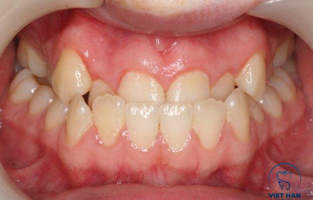 Khớp cắn ngược: Dấu hiệu, nguyên nhân và hướng điều trị 