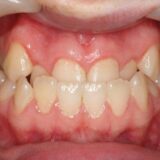 Khớp cắn ngược là tình trạng hàm dưới nhô ra trước, làm mất cân đối khuôn mặt.