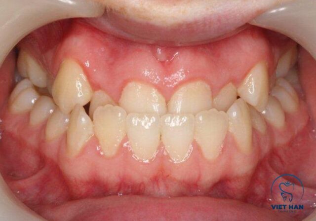 Khớp cắn ngược là tình trạng hàm dưới nhô ra trước, làm mất cân đối khuôn mặt.