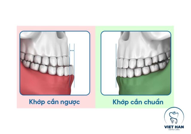 Dấu hiệu khớp cắn ngược gồm cằm nhô, răng dưới chìa ra và khớp cắn lệch.