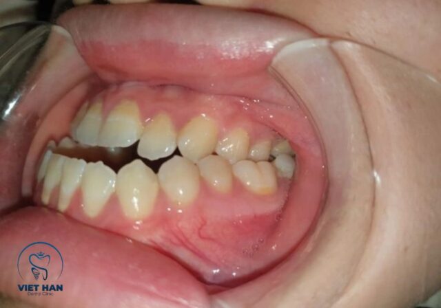 Khớp cắn ngược có thể do di truyền, thói quen xấu hoặc phát triển xương hàm bất thường.